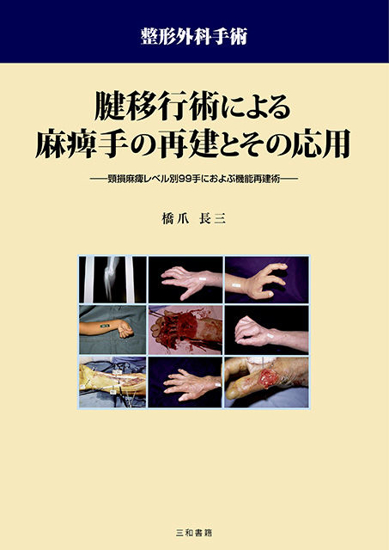 腱移行術による麻痺手の再建とその応用 の画像
